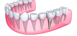 Fernando Peres - Implante Dentário